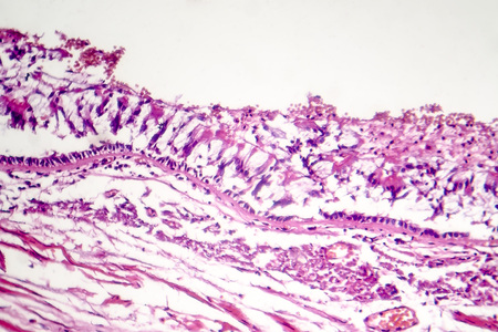 Chronic bronchitis, photo under microscope, light micrographの写真素材