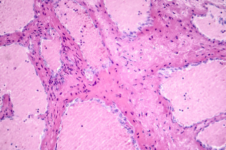 Hepatic cavernous hemangioma, a benign liver tumor, light micrograph, photo under microscopeの写真素材