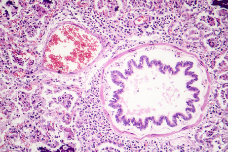 Lobar pneumonia, red hepatic phase, light micrograph, photo under microscope