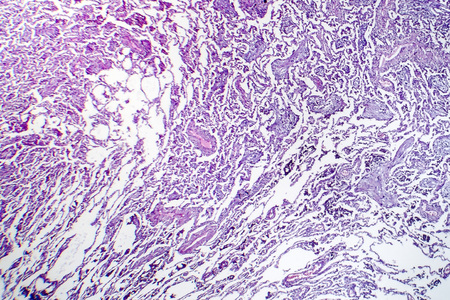 Lobar pneumonia, resolution period, light micrograph, photo under microscopeの写真素材