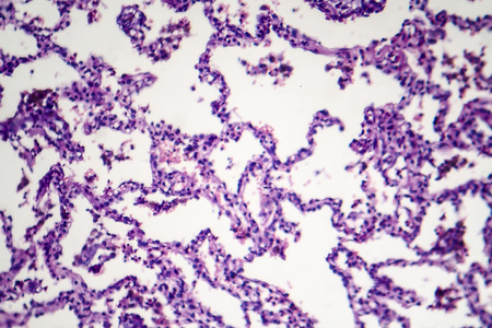 Lobar pneumonia, resolution period, light micrograph, photo under microscope