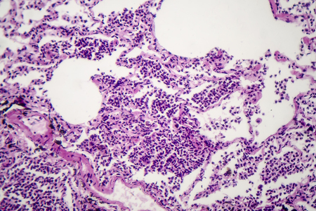 Histopathology of interstitial pneumonia, light micrograph, photo under microscope showing diffuse...