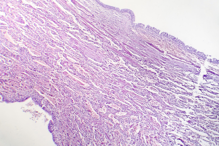 Histopathology of viral pneumonia, light micrograph, photo under microscopeの写真素材