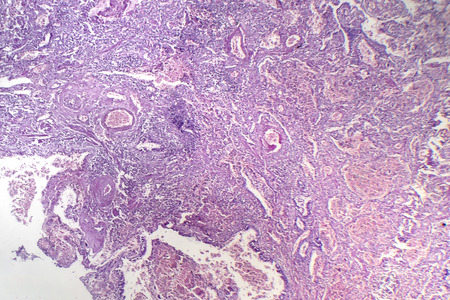 Histopathology of viral pneumonia, light micrograph, photo under microscopeの写真素材