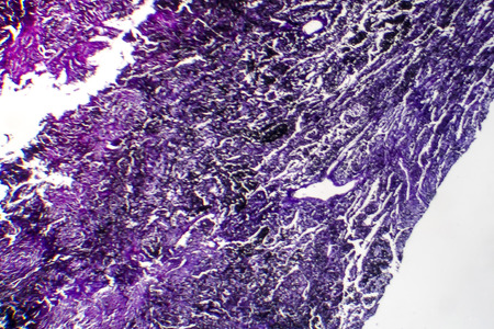 Histopathology of silicosis, the most prevalent chronic occupational disease. Light micrograph,...