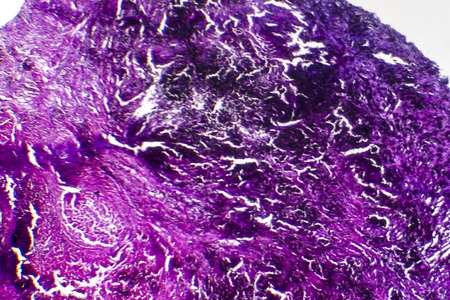 Histopathology of silicosis, the most prevalent chronic occupational disease. Light micrograph, photo under microscopeの写真素材