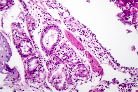 Histopathology of bronchopneumonia, light micrograph, photo under microscope