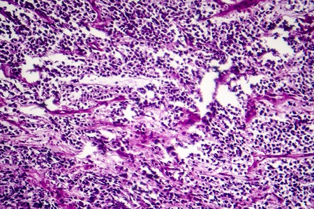Small cell lung cancer, light micrograph, photo under microscope