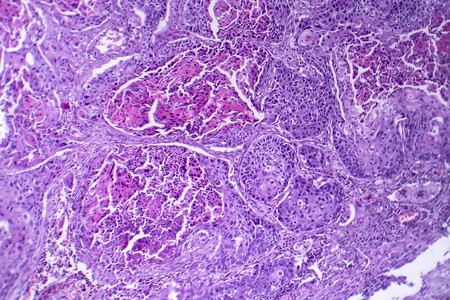 Squamous cell carcinoma of the lung, light micrograph, photo under microscopeの写真素材