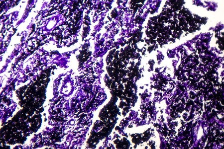 Histopathology of silicosis, the most prevalent chronic occupational disease. Light micrograph, photo under microscopeの写真素材