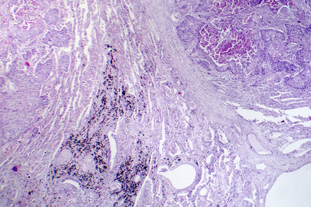 Squamous cell carcinoma of the lung, light micrograph, photo under microscopeの写真素材