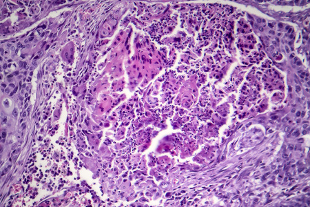 Squamous cell carcinoma of the lung, light micrograph, photo under microscopeの写真素材