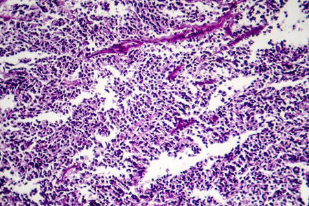 Small cell lung cancer, light micrograph, photo under microscopeの写真素材