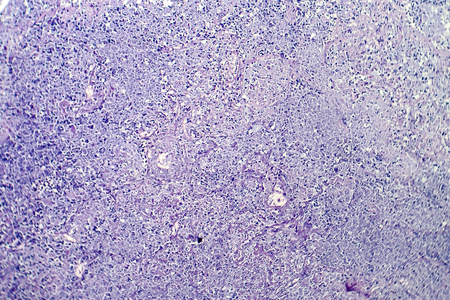 Histopathology of tuberculosis, light micrograph of tuberculosis lesion, photo under microscope at...