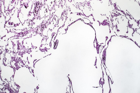Histopathology of lung emphysema, light micrograph, photo under microscope showing enlargement of...