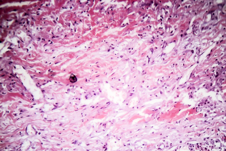 Histopathology of tuberculous pleurisy, light micrograph, photo under microscope