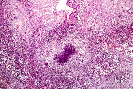 Histopathology of tubercle, light micrograph, photo under microscope