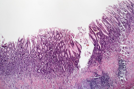 Histopathology of chronic atrophic gastritis, light micrograph, photo under microscope