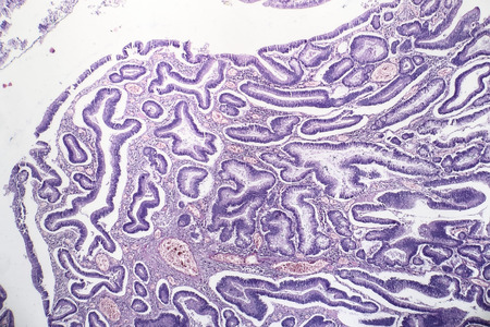 Histopathology of intestinal adenoma, light micrograph, photo under microscopeの写真素材