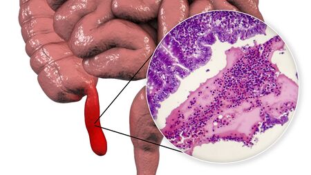 Acute suppurative appendicitis, 3D illustration of human intestine with inflammed appendix and light...