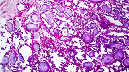 Histopathology of prostate gland hyperplasia, light micrograph, photo under microscope