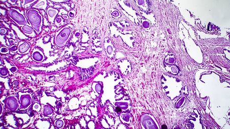 Histopathology of prostate gland hyperplasia, light micrograph, photo under microscope