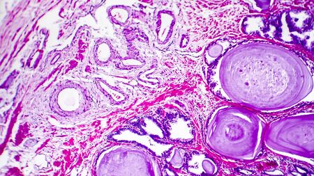 Histopathology of prostate gland hyperplasia, light micrograph, photo under microscopeの写真素材