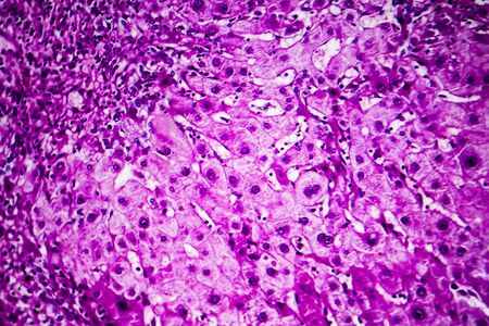 Histopathology of portal liver cirrhosis, light micrograph, photo under microscopeの写真素材