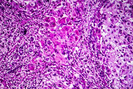 Histopathology of portal liver cirrhosis, light micrograph, photo under microscopeの写真素材