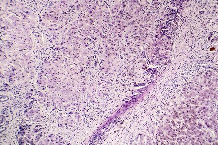 Histopathology of postnecrotic liver cirrhosis, light micrograph, photo under microscopeの写真素材