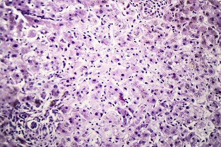 Histopathology of postnecrotic liver cirrhosis, light micrograph, photo under microscopeの写真素材