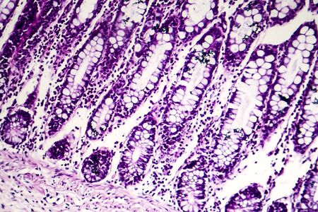 Bacillary dysentery, light micrograph, photo under microscope showing presence of bacteria and...