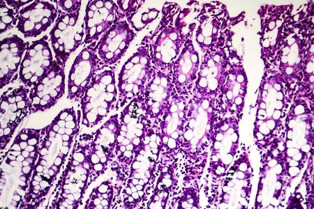 Bacillary dysentery, light micrograph, photo under microscope showing presence of bacteria and accumulation of inflammatory cellsの写真素材