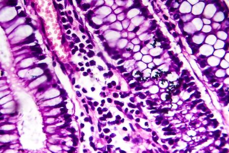 Bacillary dysentery, light micrograph, photo under microscope showing presence of bacteria and...