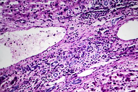 Hepatocellular carcinoma, cancer of liver, light micrograph, photo under microscope