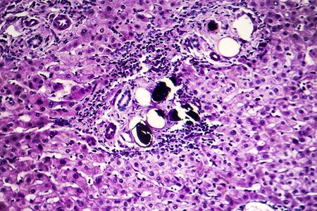 Liver schistosomiasis, light micrograph, photo under microscope showing presence of Schistosoma ova,...
