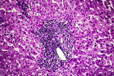 Liver schistosomiasis, light micrograph, photo under microscope showing presence of Schistosoma ova,...