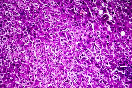 Liver edema, light micrograph, photo under microscopeの写真素材