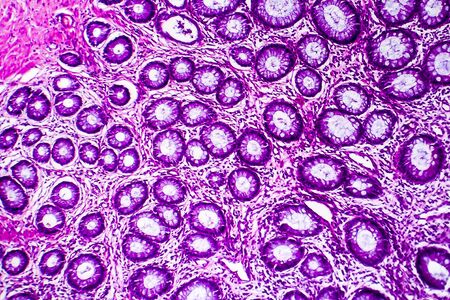 Well-differentiated intestinal adenocarcinoma, light micrograph, photo under microscope