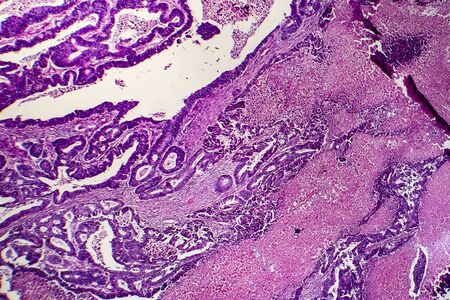 Differentiated intestinal adenocarcinoma, light micrograph, photo under microscopeの写真素材