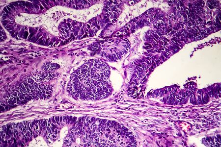 Differentiated intestinal adenocarcinoma, light micrograph, photo under microscope