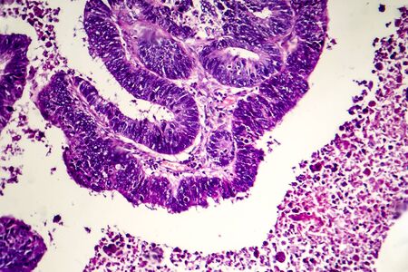 Differentiated intestinal adenocarcinoma, light micrograph, photo under microscope