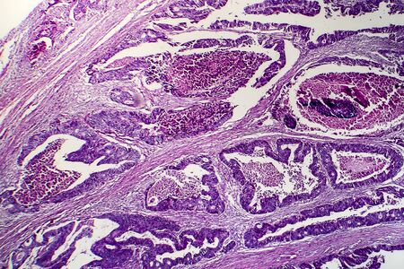 Differentiated intestinal adenocarcinoma, light micrograph, photo under microscopeの写真素材