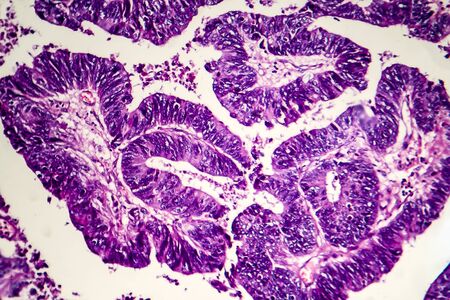 Differentiated intestinal adenocarcinoma, light micrograph, photo under microscopeの写真素材
