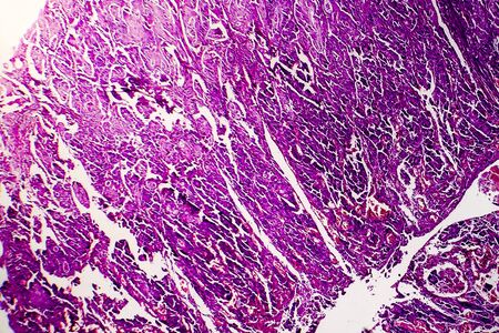 Poorly differentiated intestinal adenocarcinoma, light micrograph, photo under microscope