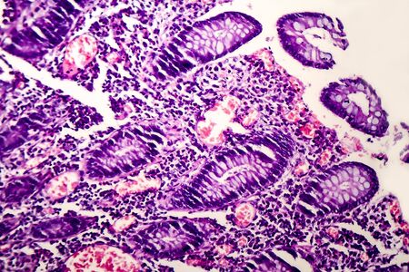 Poorly differentiated intestinal adenocarcinoma, light micrograph, photo under microscopeの写真素材
