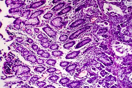 Poorly differentiated intestinal adenocarcinoma, light micrograph, photo under microscopeの写真素材