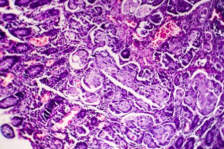 Poorly differentiated intestinal adenocarcinoma, light micrograph, photo under microscopeの写真素材