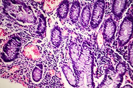 Poorly differentiated intestinal adenocarcinoma, light micrograph, photo under microscope