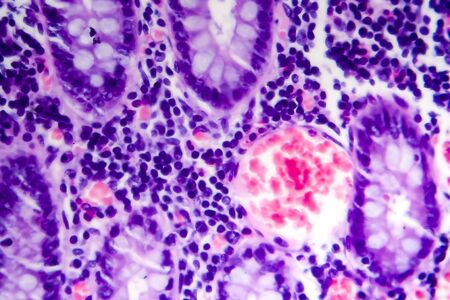 Poorly differentiated intestinal adenocarcinoma, light micrograph, photo under microscope. High...